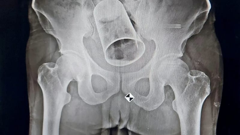 Muž nebyl několik dní na záchodě. Předmět, který našli v jeho konečníku, lékaře šokoval