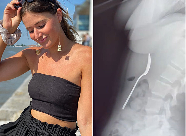 Žena spolkla celou lžičku, mohla za to bizarní nehoda