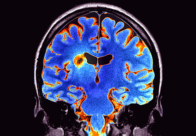 Roztroušená skleróza mi změnila život k lepšímu, říká pacient