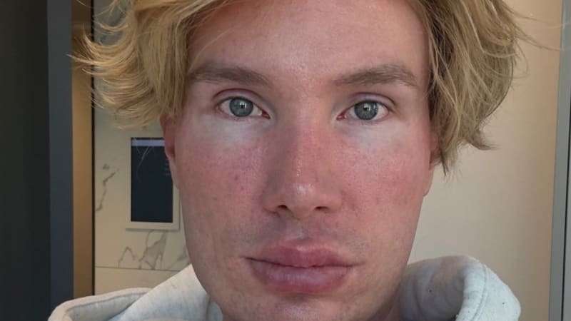 Toužil po dokonalé tváři, málem přišel o zrak. Známý influencer hodiny trpěl, ze snímků mrazí