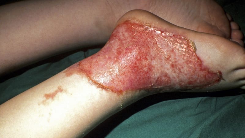 Gelová hračka explodovala vedrem. Chlapce v Británii vážně popálila, musel na transplantaci
